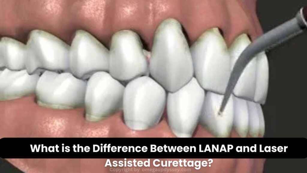 What is the Difference Between LANAP and Laser Assisted Curettage?