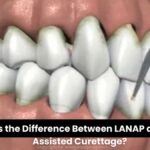 What is the Difference Between LANAP and Laser Assisted Curettage?